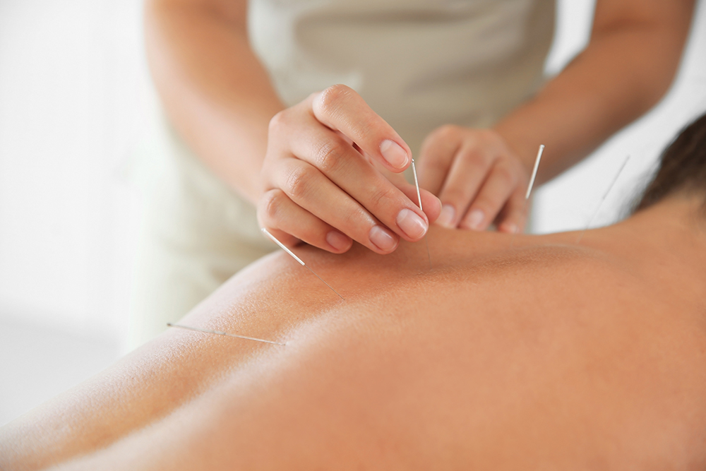 Acupuncture