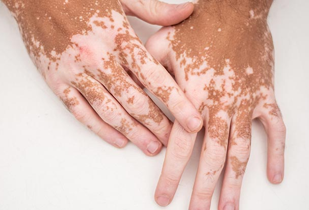 pigmentation