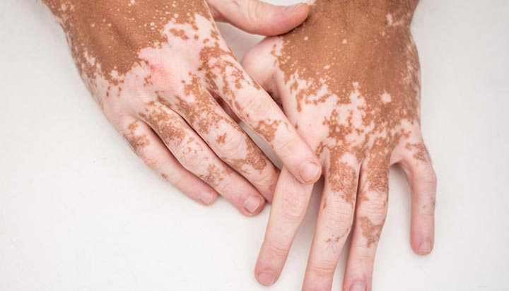 pigmentation